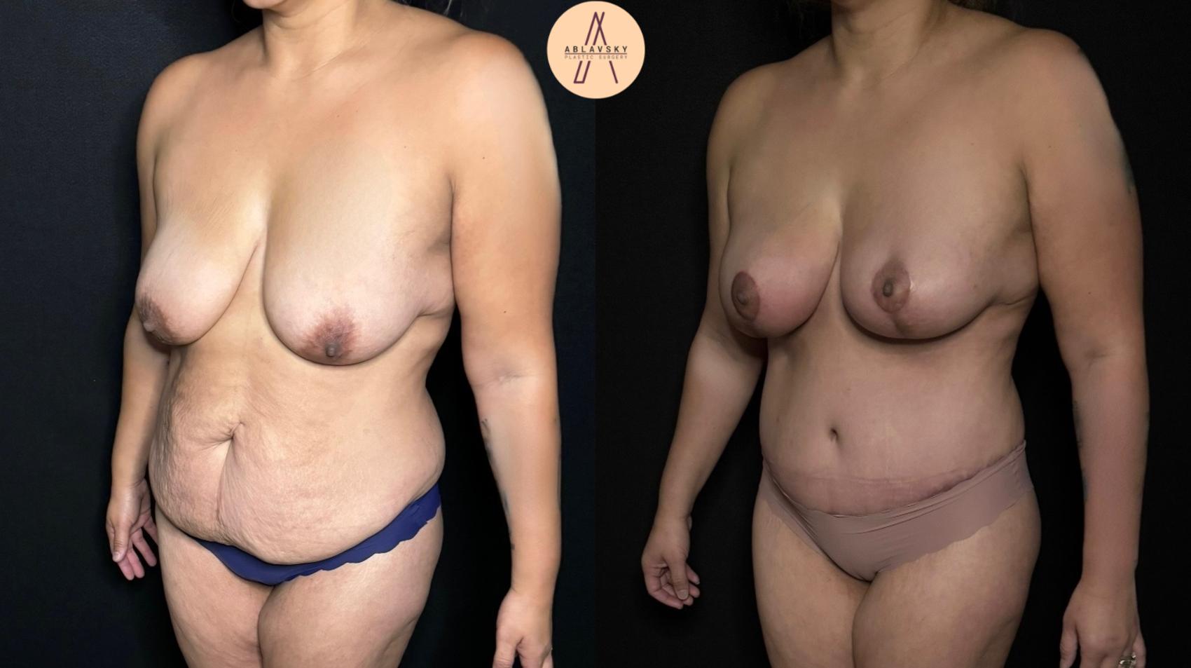 Before & After Mommy Makeover Case 304 Left Oblique View in San Antonio, Texas
