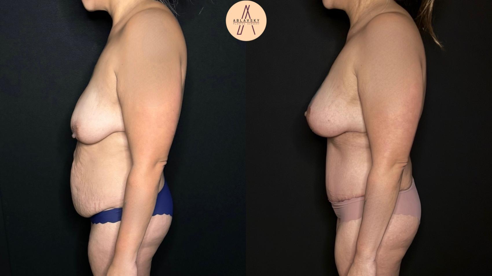 Before & After Mommy Makeover Case 304 Left Side View in San Antonio, Texas