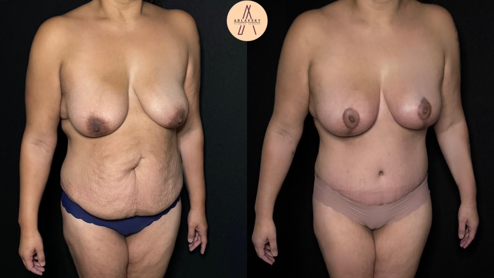 Before & After Mommy Makeover Case 304 Right Oblique View in San Antonio, Texas