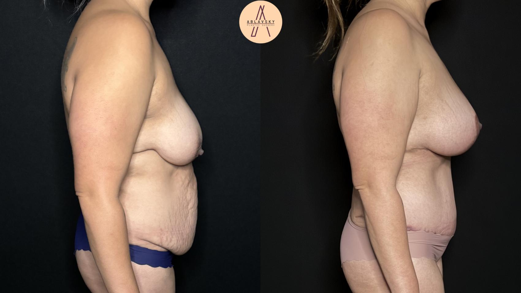 Before & After Mommy Makeover Case 304 Right Side View in San Antonio, Texas