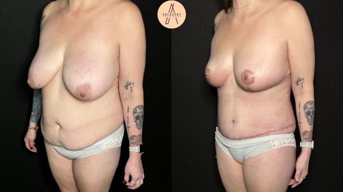 Before & After Mommy Makeover Case 309 Left Oblique View in San Antonio, Texas