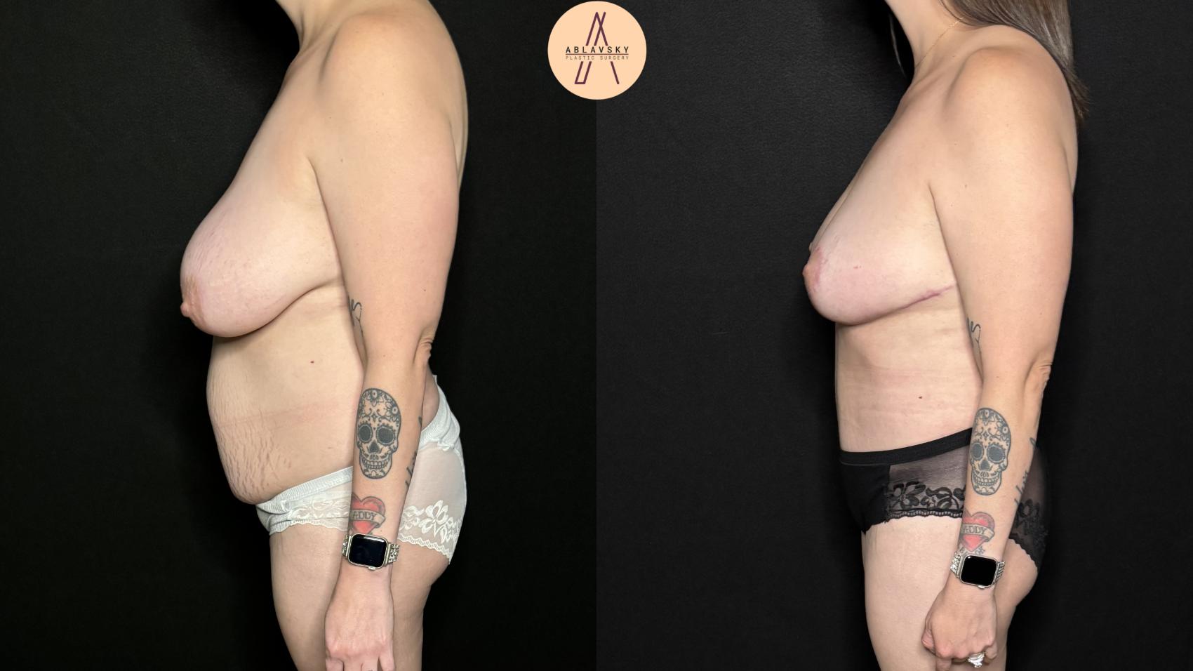 Before & After Breast Lift Case 309 Left Side View in San Antonio, Texas