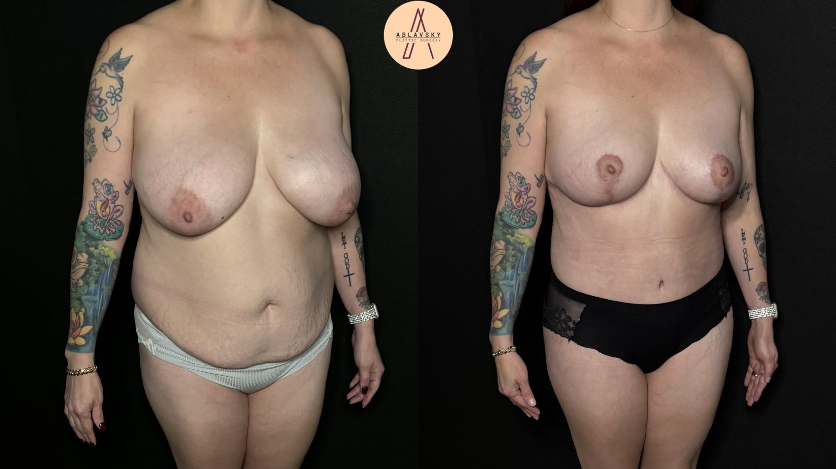 Before & After Breast Lift Case 309 Right Oblique View in San Antonio, Texas