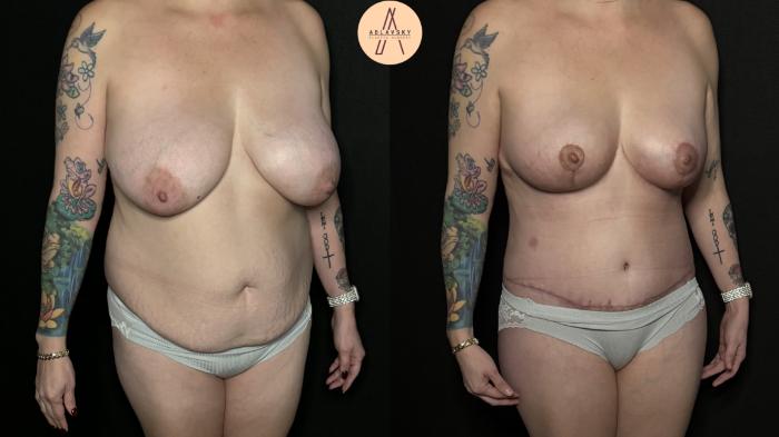 Before & After Mommy Makeover Case 309 Right Oblique View in San Antonio, Texas