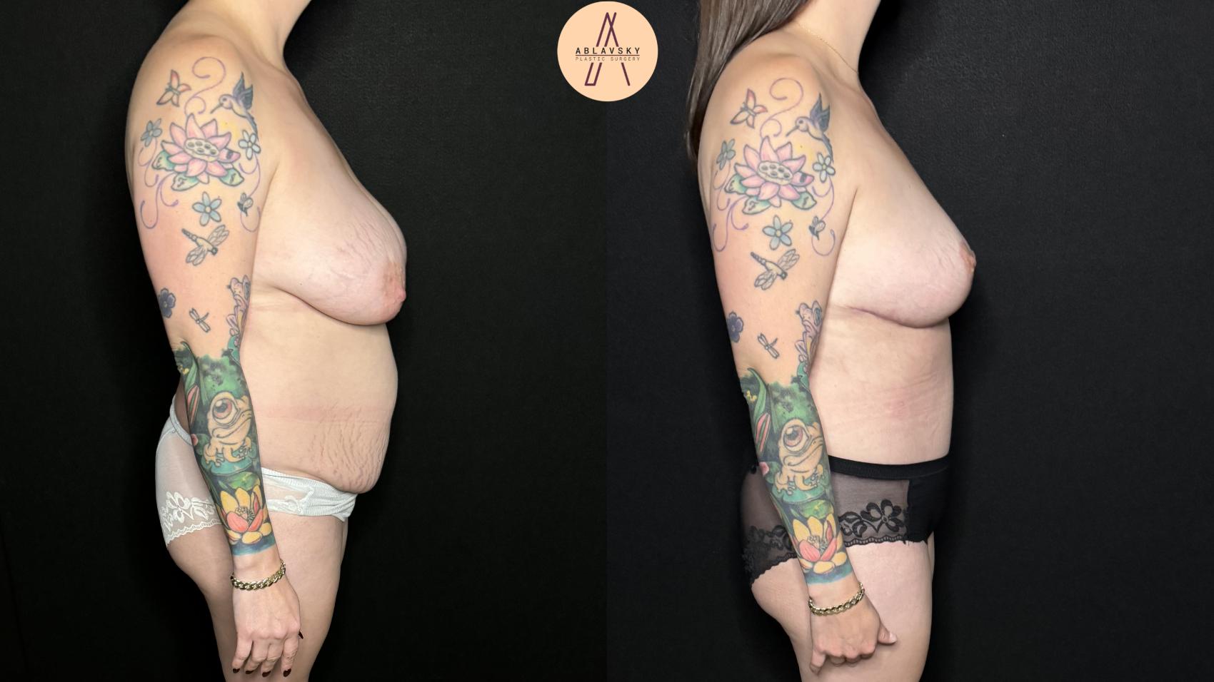Before & After Breast Lift Case 309 Right Side View in San Antonio, Texas