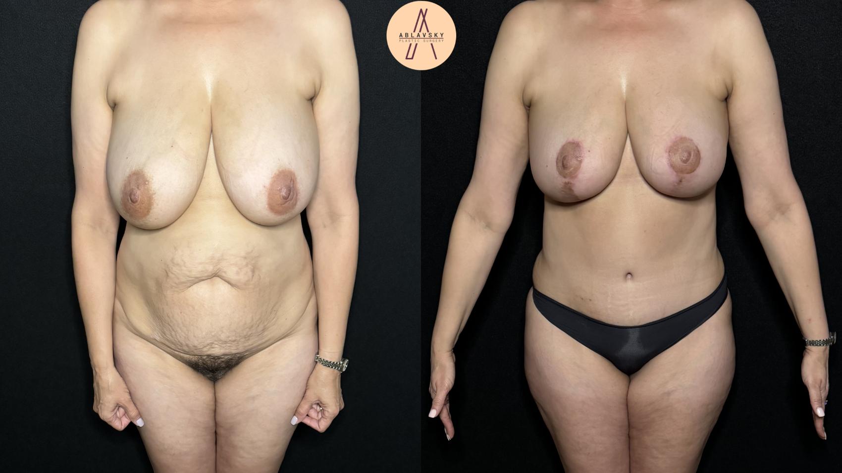 Before & After Tummy Tuck Case 310 Front View in San Antonio, Texas