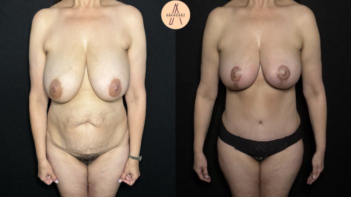 Before & After Liposuction Case 310 Front View in San Antonio, Texas