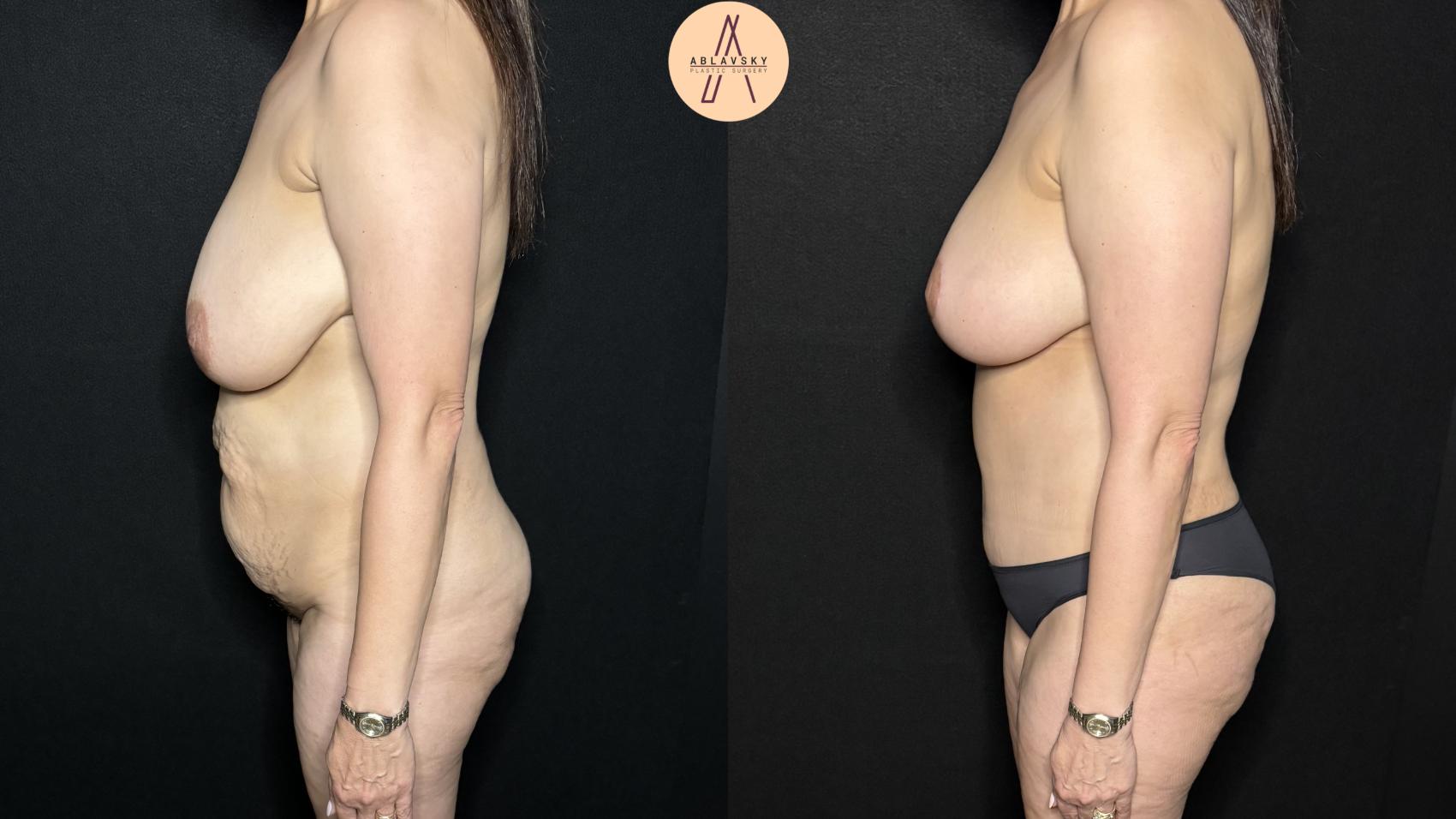 Before & After Tummy Tuck Case 310 Left Side View in San Antonio, Texas