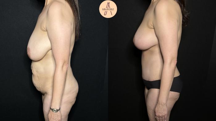 Before & After Liposuction Case 310 Left Side View in San Antonio, Texas