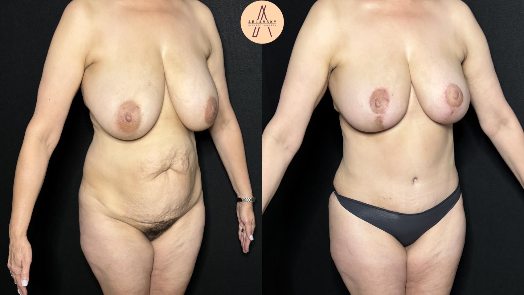 Before & After Tummy Tuck Case 310 Right Oblique View in San Antonio, Texas