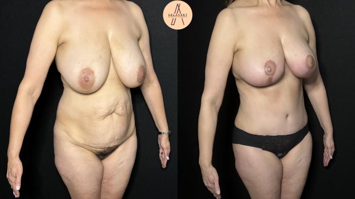 Before & After Liposuction Case 310 Right Oblique View in San Antonio, Texas