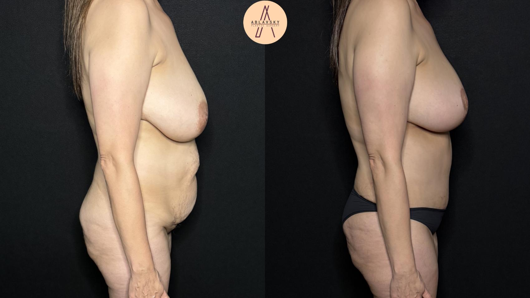 Before & After Tummy Tuck Case 310 Right Side View in San Antonio, Texas