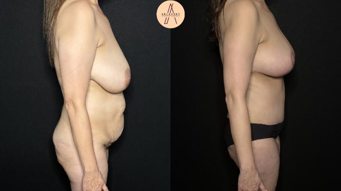 Before & After Liposuction Case 310 Right Side View in San Antonio, Texas