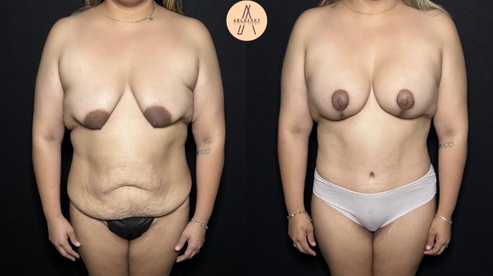 Before & After Mommy Makeover Case 312 Front View in San Antonio, Texas