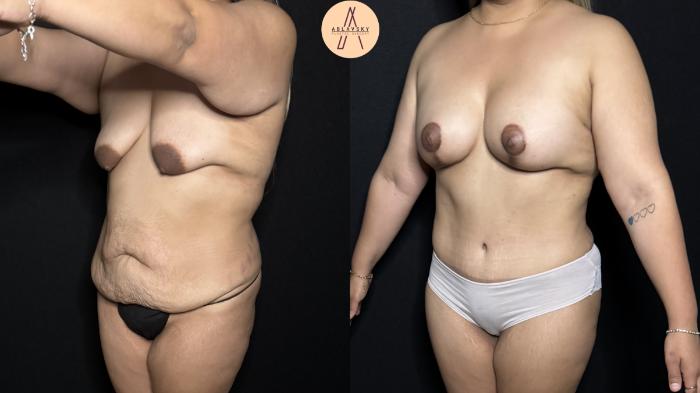 Before & After Mommy Makeover Case 312 Left Oblique View in San Antonio, Texas