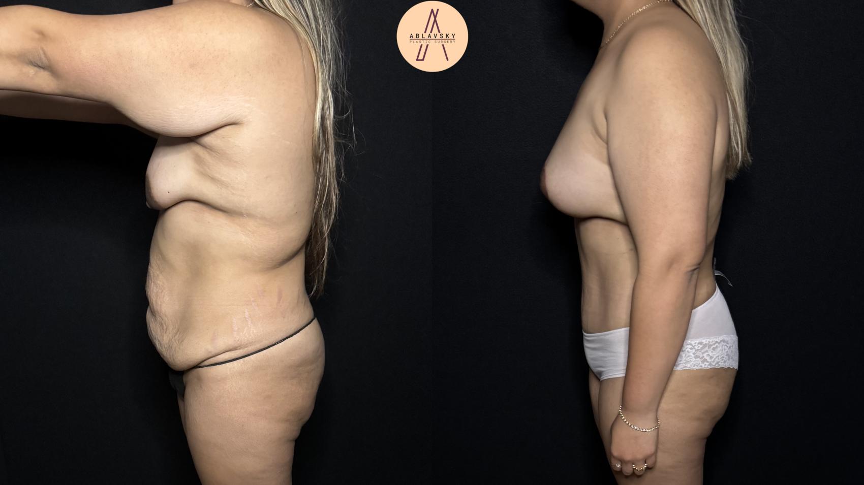 Before & After Mommy Makeover Case 312 Left Side View in San Antonio, Texas
