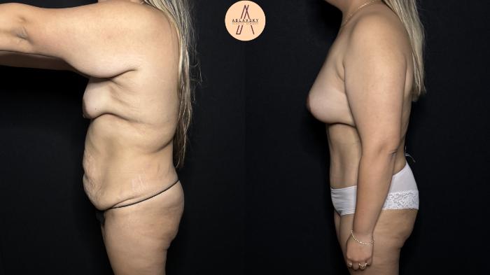 Before & After Mommy Makeover Case 312 Left Side View in San Antonio, Texas