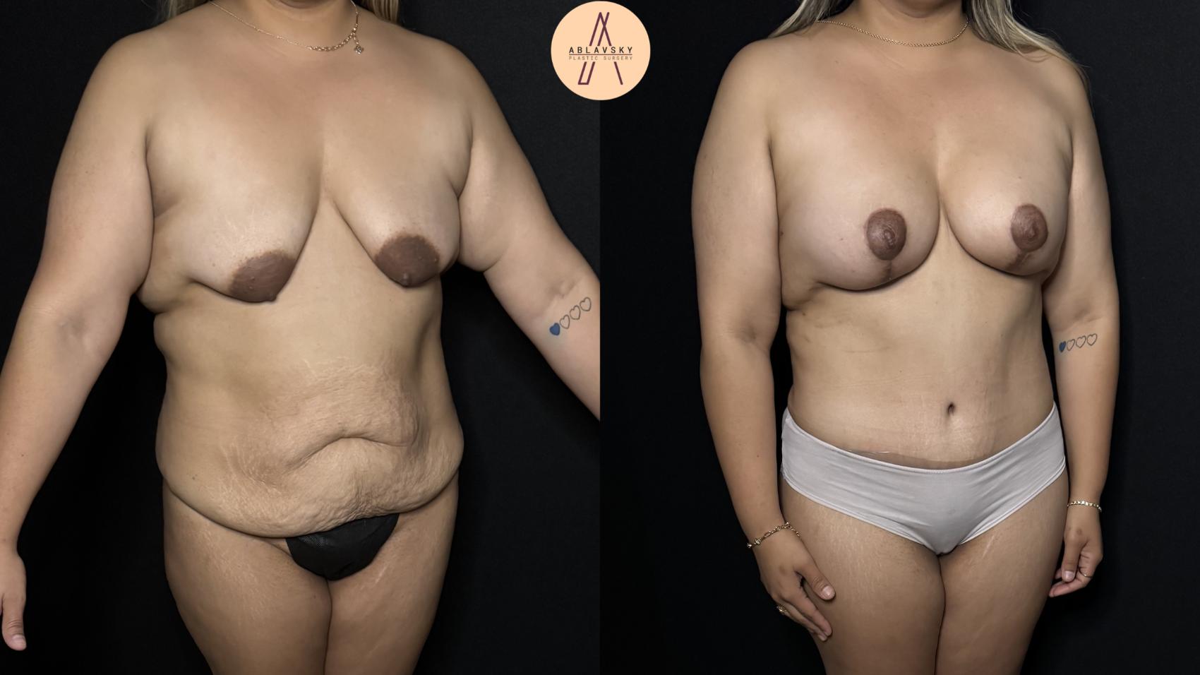 Before & After Mommy Makeover Case 312 Right Oblique View in San Antonio, Texas