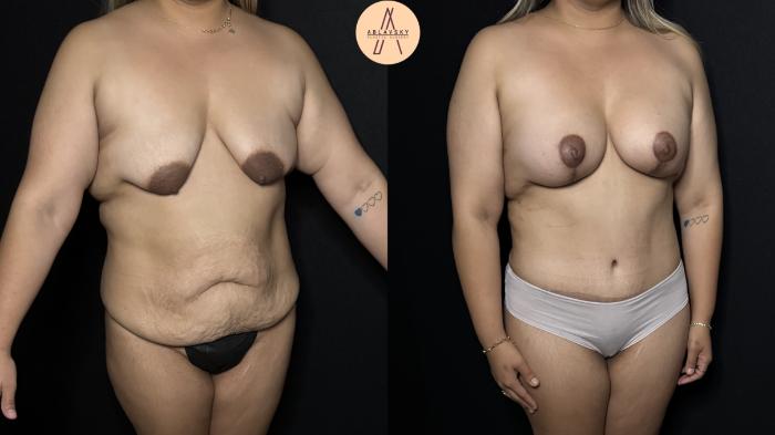 Before & After Mommy Makeover Case 312 Right Oblique View in San Antonio, Texas