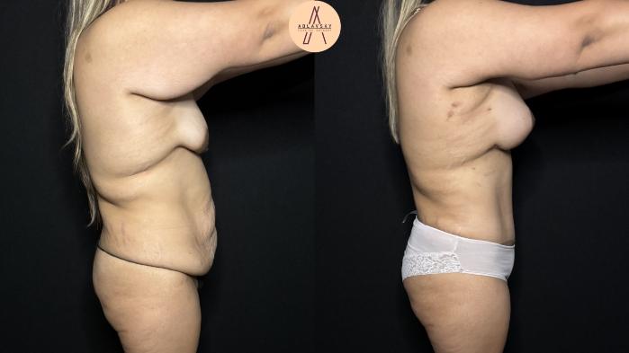 Before & After Mommy Makeover Case 312 Right Side View in San Antonio, Texas