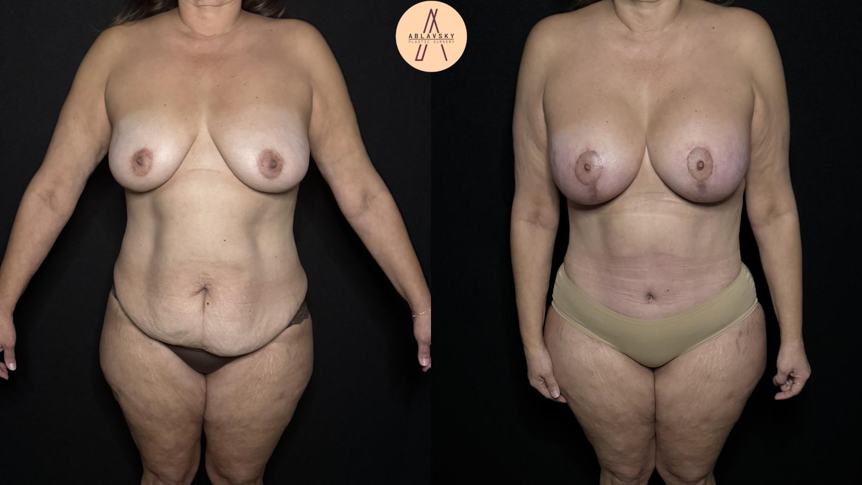 Before & After Tummy Tuck Case 313 Front View in San Antonio, Texas