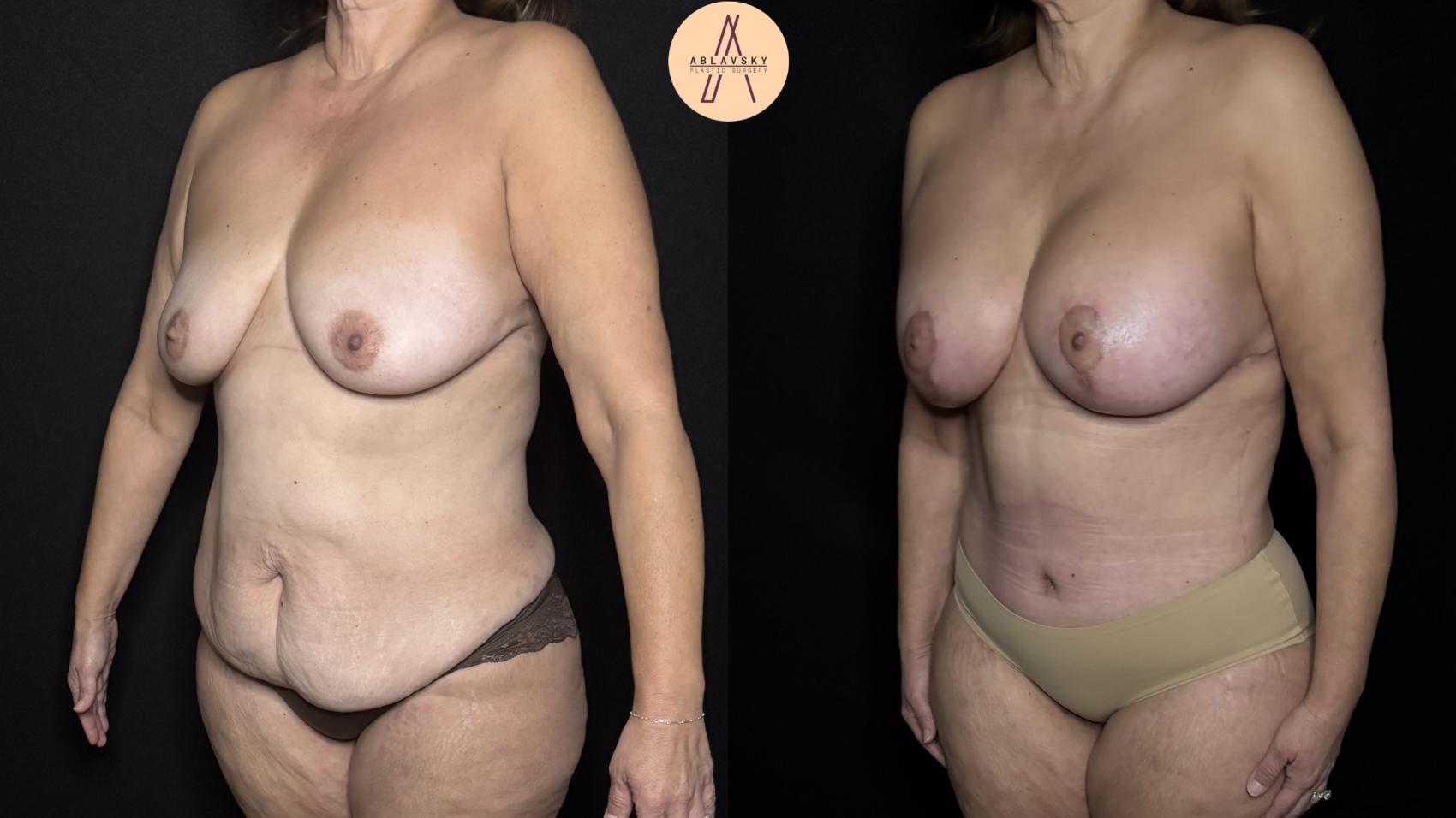 Before & After Mommy Makeover Case 313 Left Oblique View in San Antonio, Texas