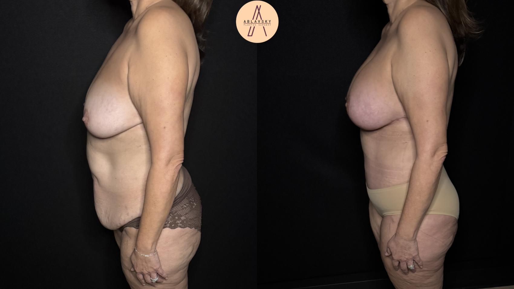 Before & After Tummy Tuck Case 313 Left Side View in San Antonio, Texas