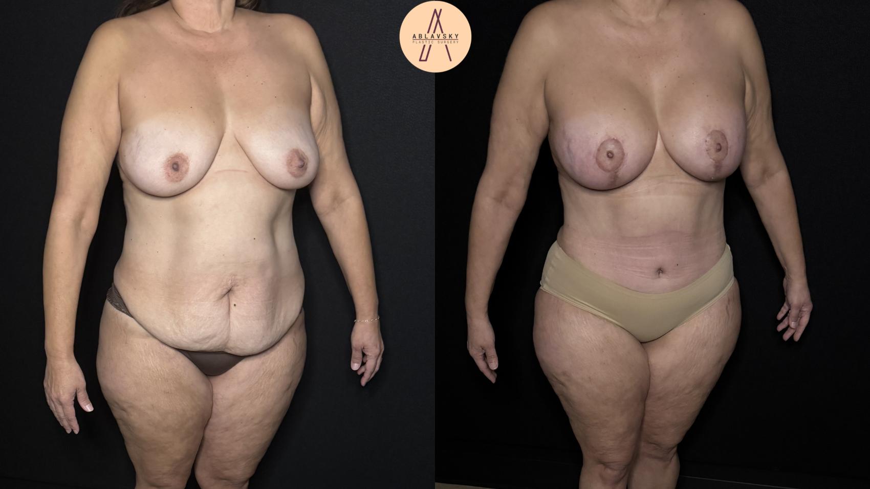 Before & After Tummy Tuck Case 313 Right Oblique View in San Antonio, Texas