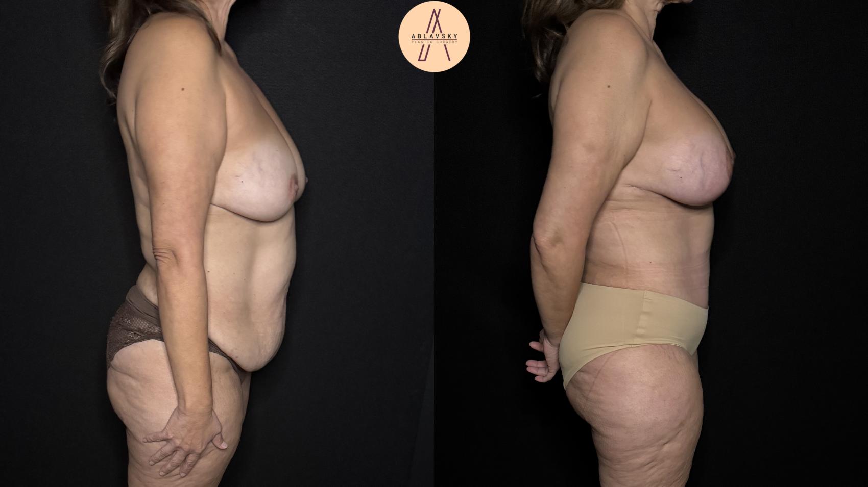 Before & After Tummy Tuck Case 313 Right Side View in San Antonio, Texas