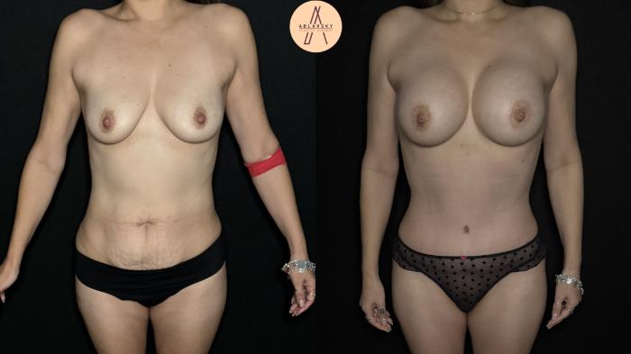 Before & After Liposuction Case 322 Front View in San Antonio, Texas