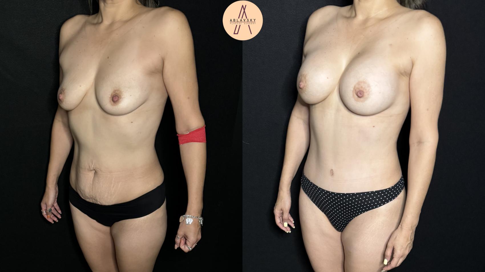 Before & After Breast Augmentation Case 322 Left Oblique View in San Antonio, Texas