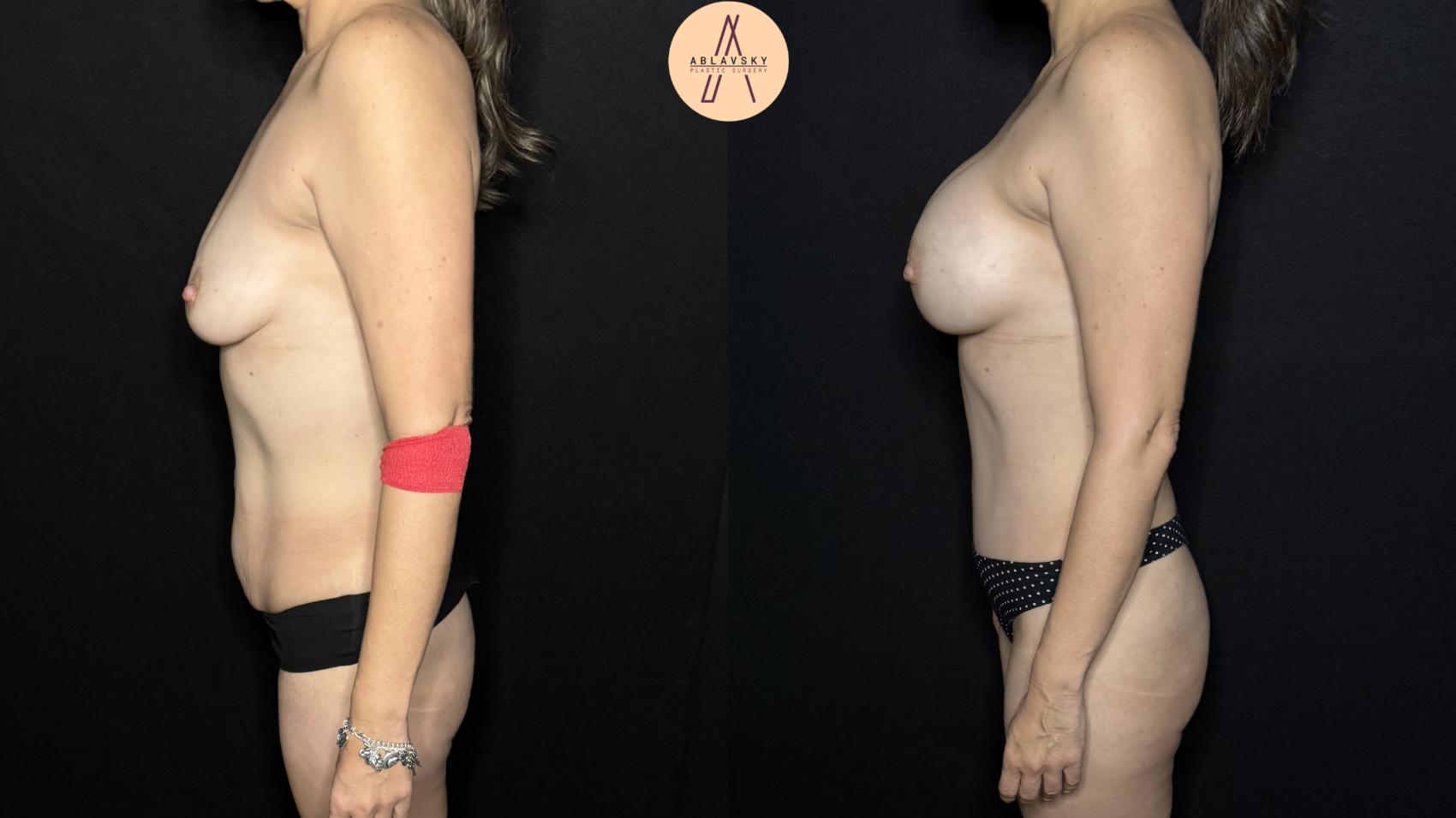 Before & After Breast Augmentation Case 322 Left Side View in San Antonio, Texas