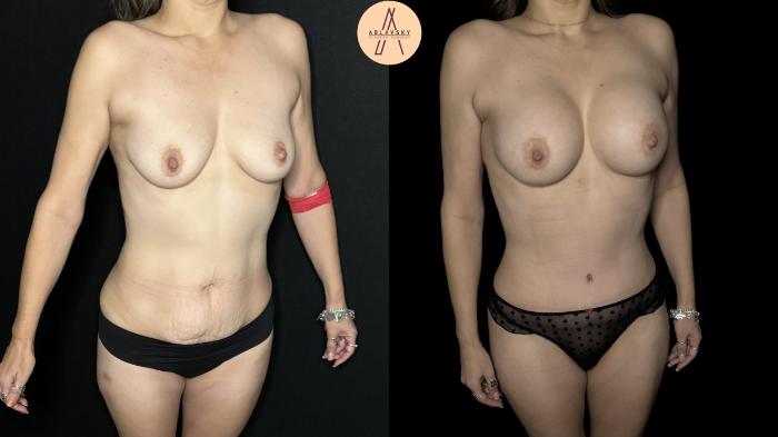 Before & After Mommy Makeover Case 322 Right Oblique View in San Antonio, Texas