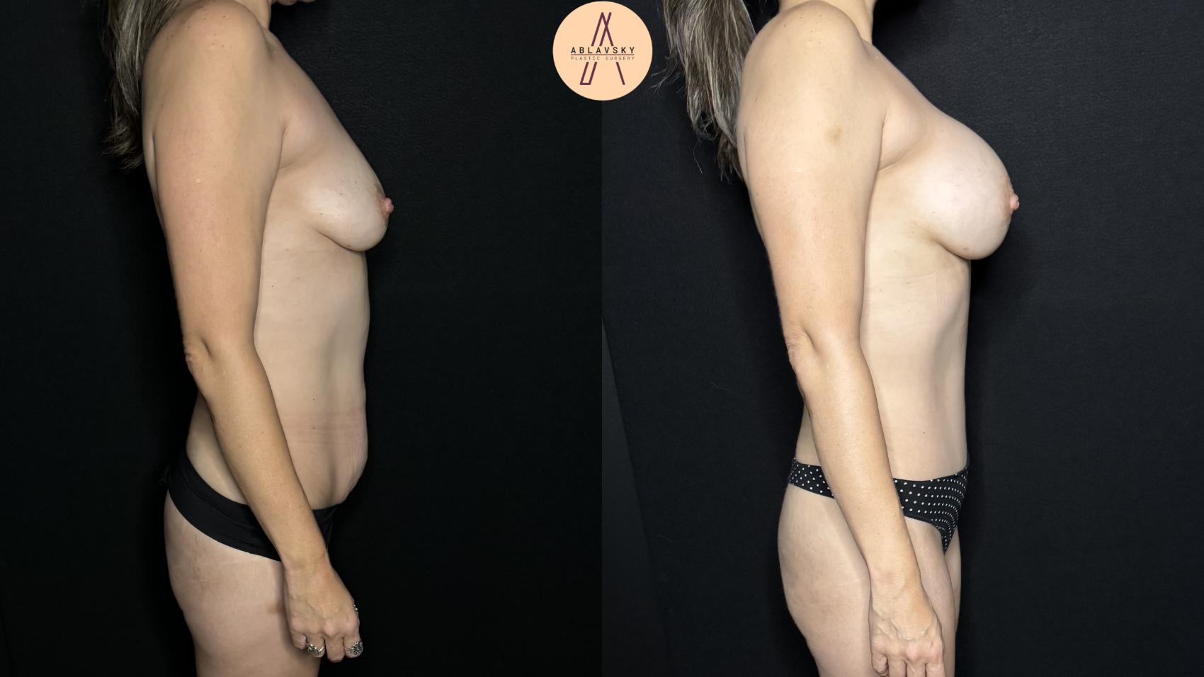 Before & After Breast Augmentation Case 322 Right Side View in San Antonio, Texas