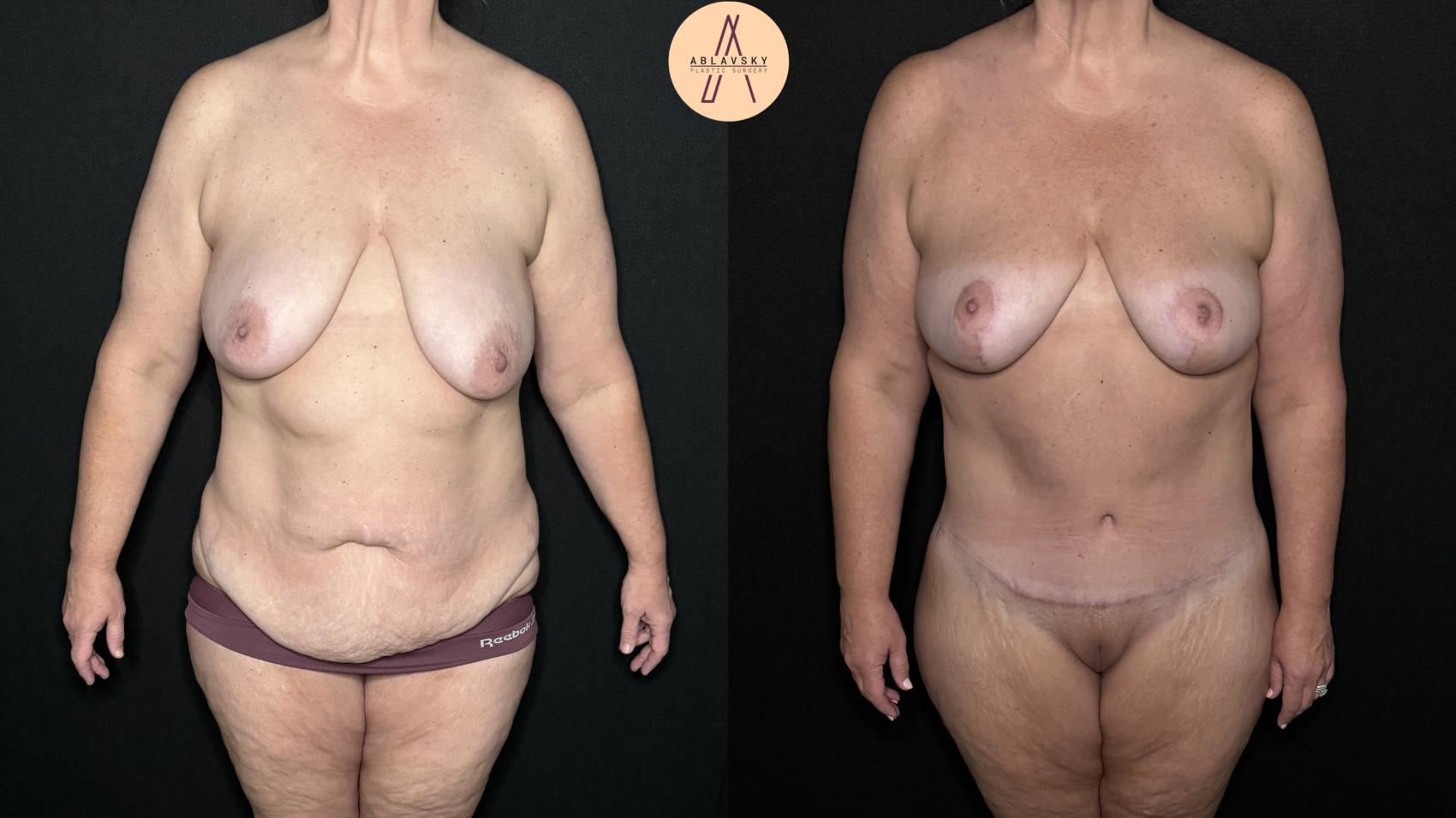 Before & After Breast Lift Case 325 Front View in San Antonio, Texas