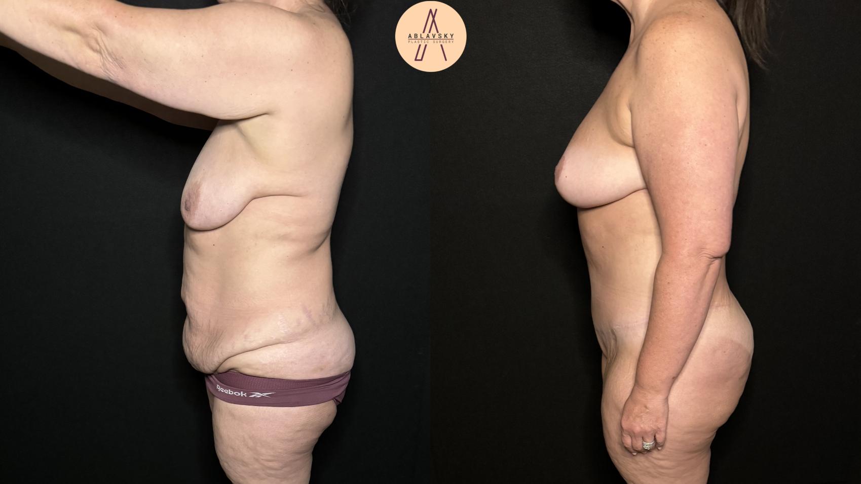 Before & After Breast Lift Case 325 Left Side View in San Antonio, Texas