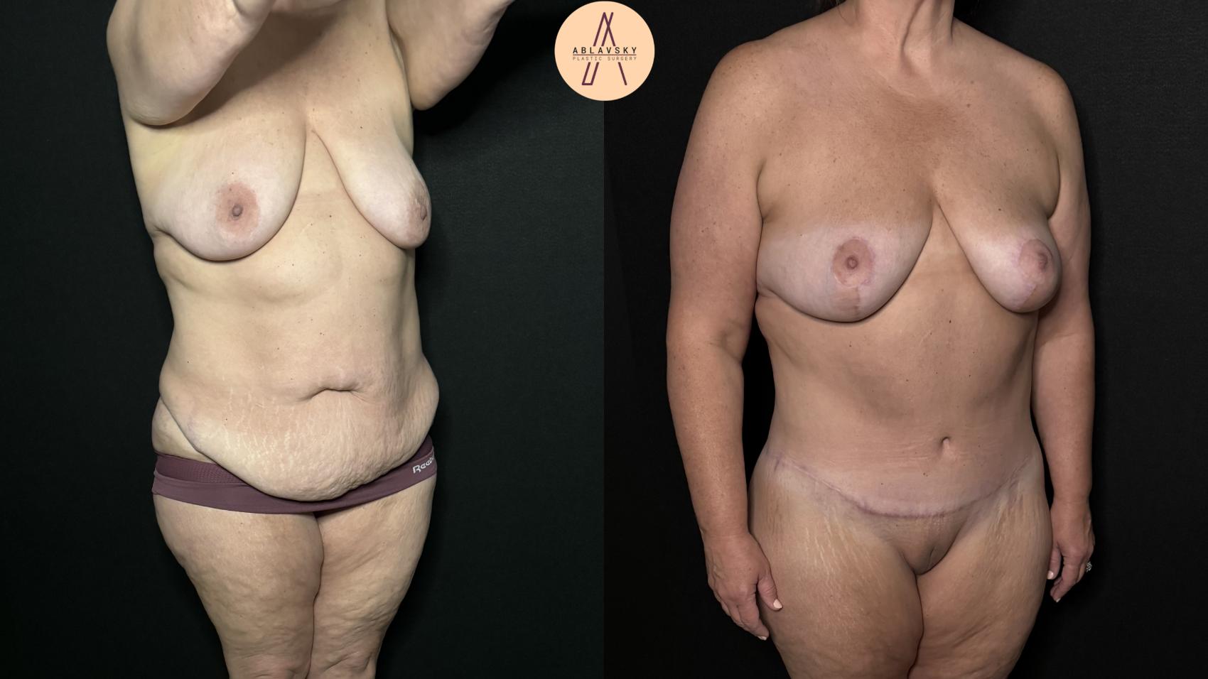 Before & After Breast Lift Case 325 Right Oblique View in San Antonio, Texas