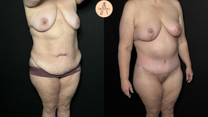 Before & After Mommy Makeover Case 325 Right Oblique View in San Antonio, Texas