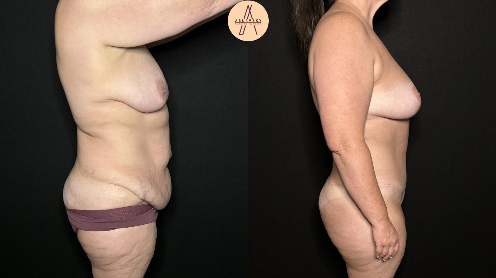 Before & After Breast Lift Case 325 Right Side View in San Antonio, Texas
