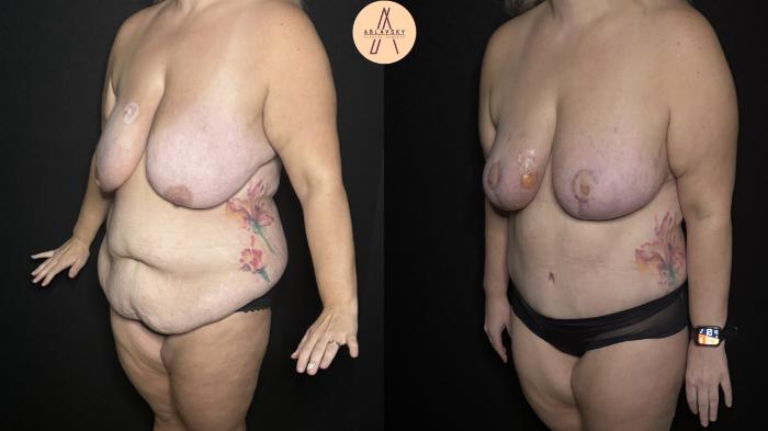 Before & After Mommy Makeover Case 328 Left Oblique View in San Antonio, Texas