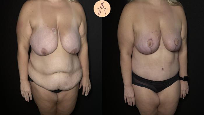 Before & After Mommy Makeover Case 328 Right Oblique View in San Antonio, Texas