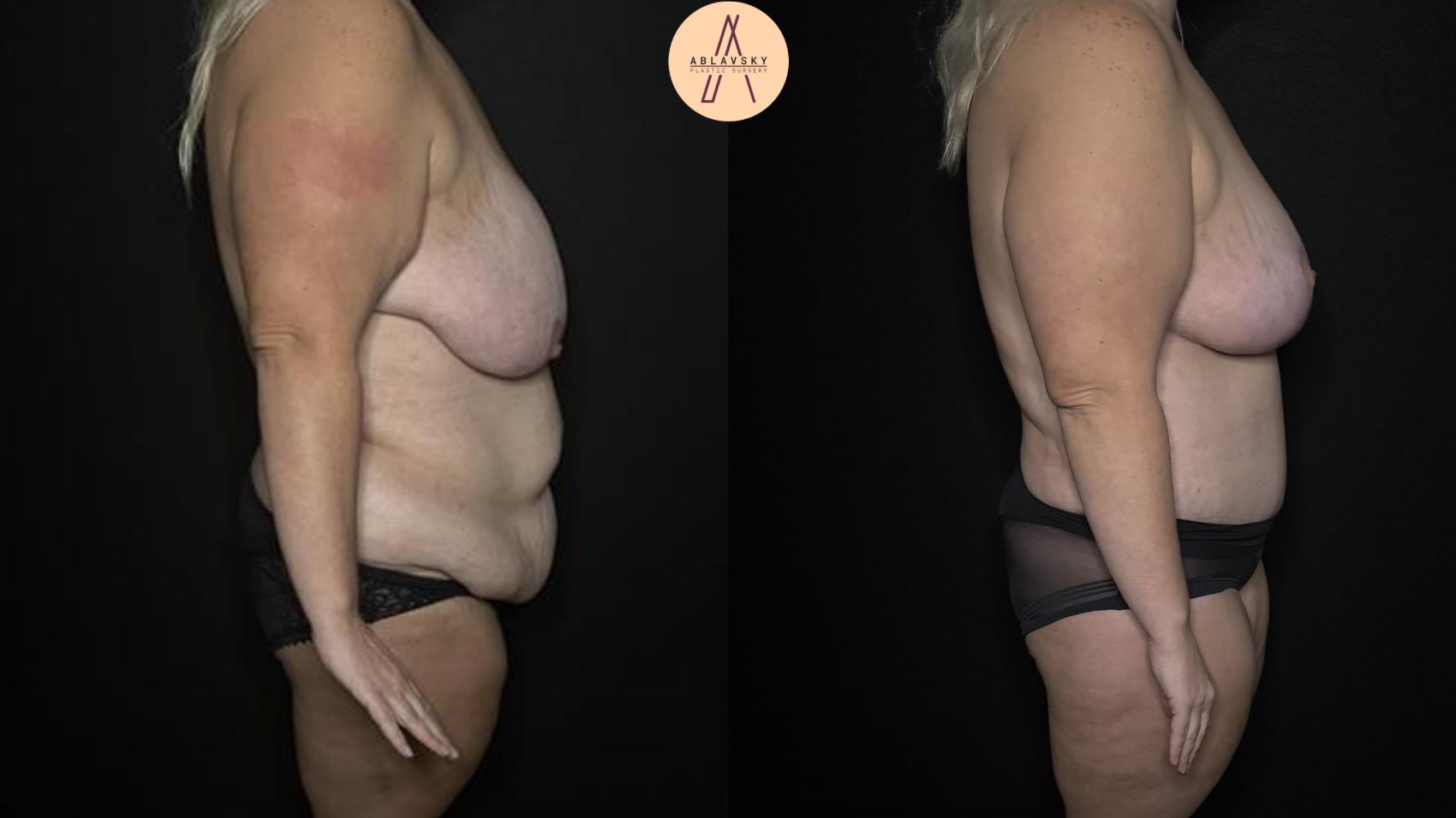 Before & After Mommy Makeover Case 328 Right Side View in San Antonio, Texas