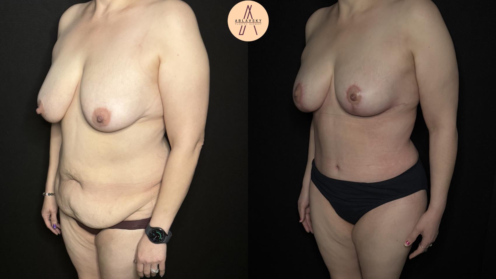 Before & After Mommy Makeover Case 333 Left Oblique View in San Antonio, Texas