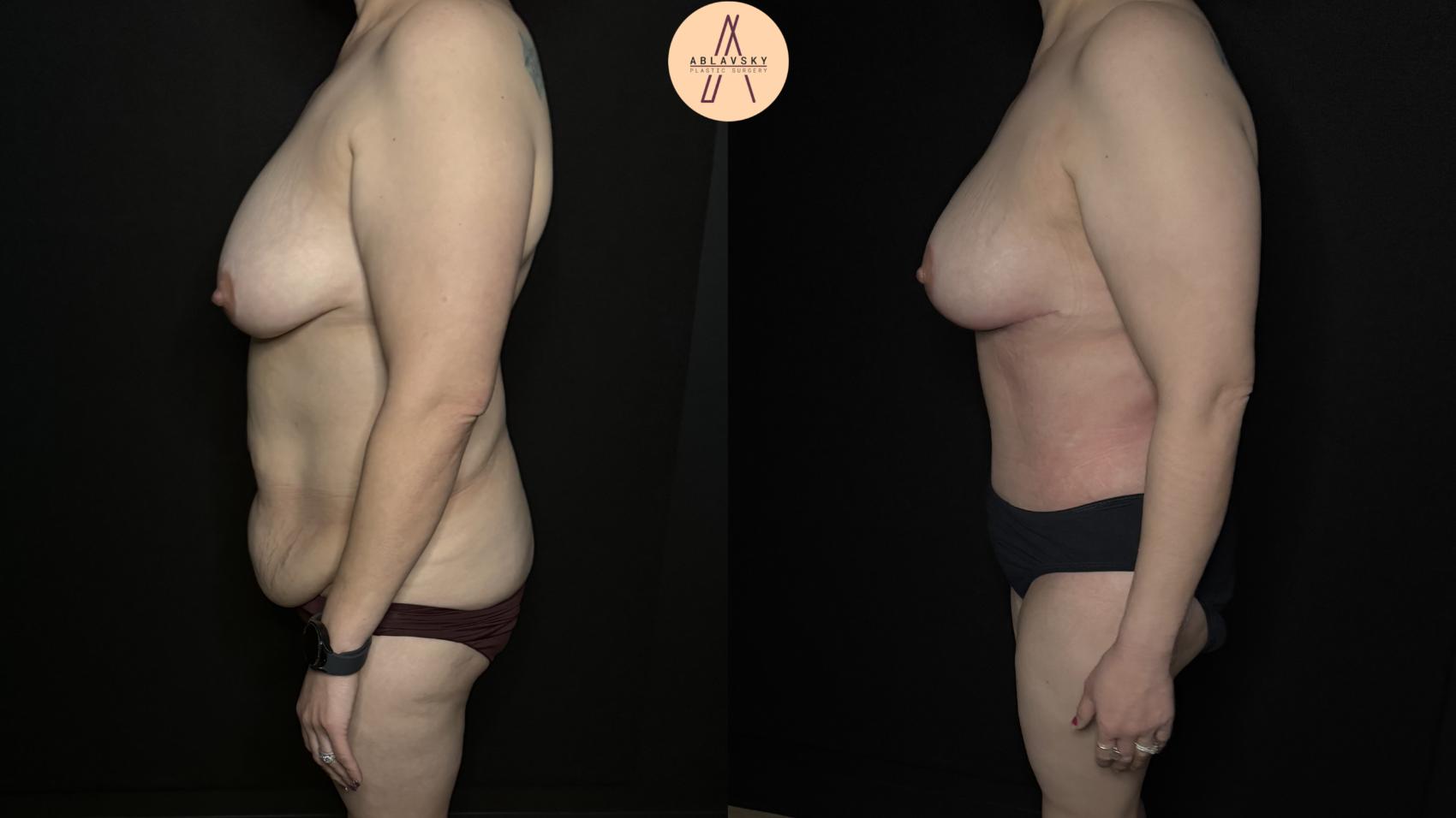 Before & After Mommy Makeover Case 333 Left Side View in San Antonio, Texas