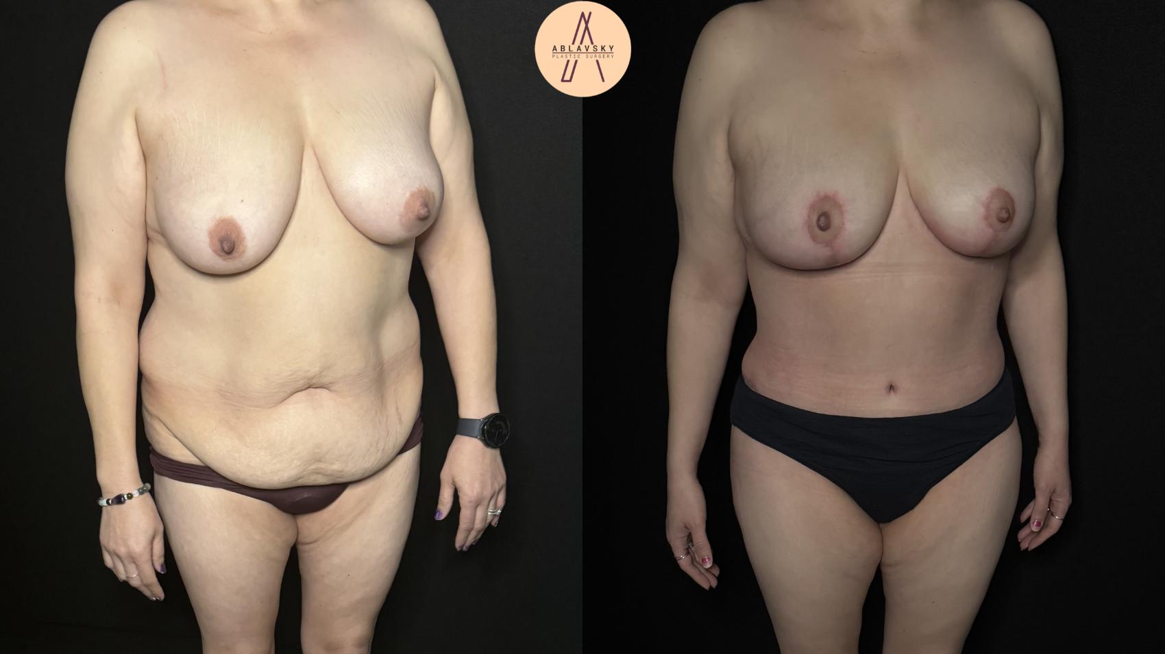 Before & After Mommy Makeover Case 333 Right Oblique View in San Antonio, Texas