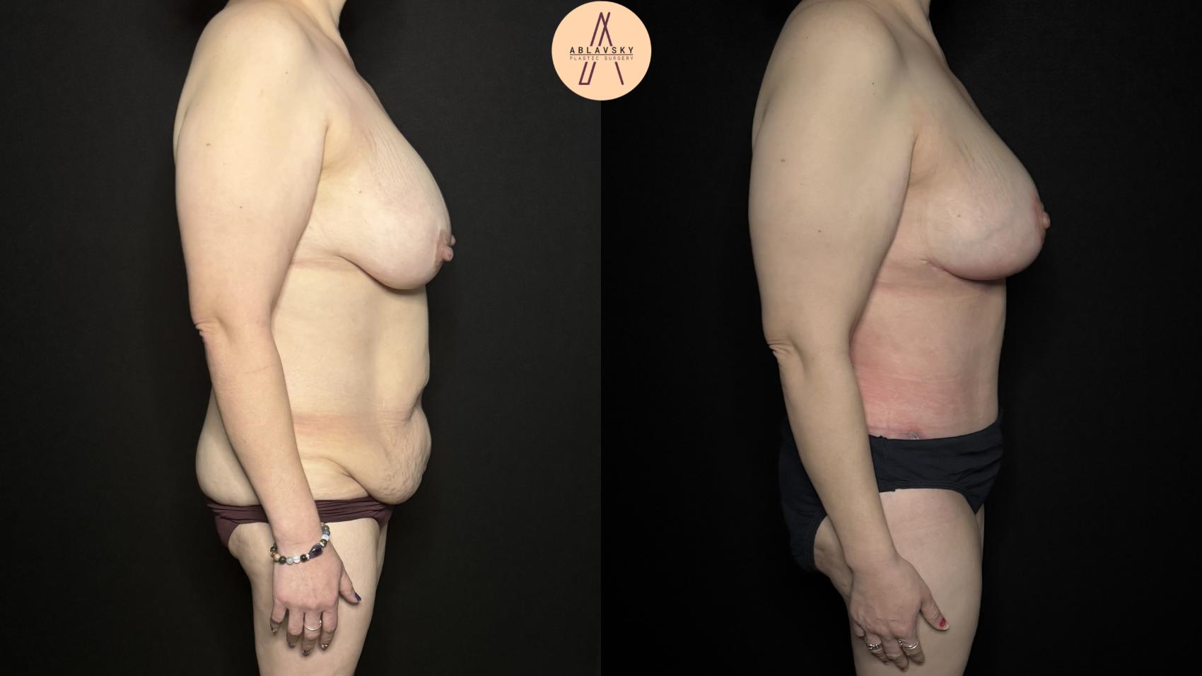 Before & After Mommy Makeover Case 333 Right Side View in San Antonio, Texas