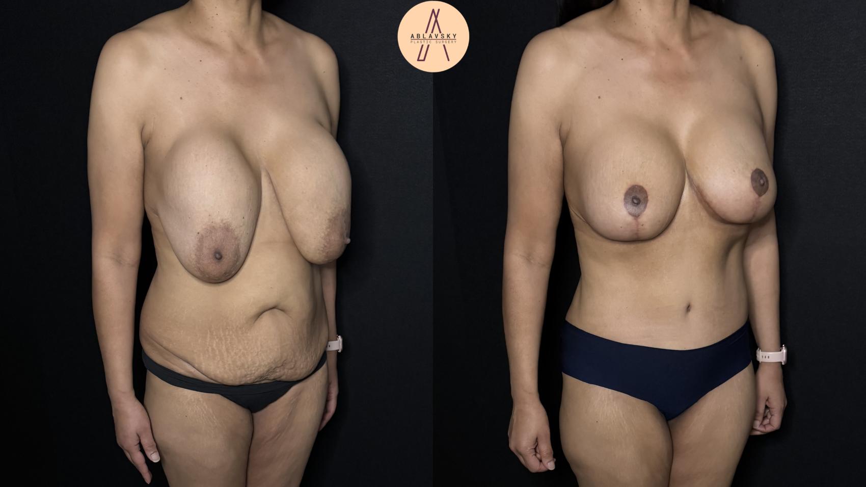 Before & After Implant Removal and Replacement  Case 337 Right Oblique View in San Antonio, Texas