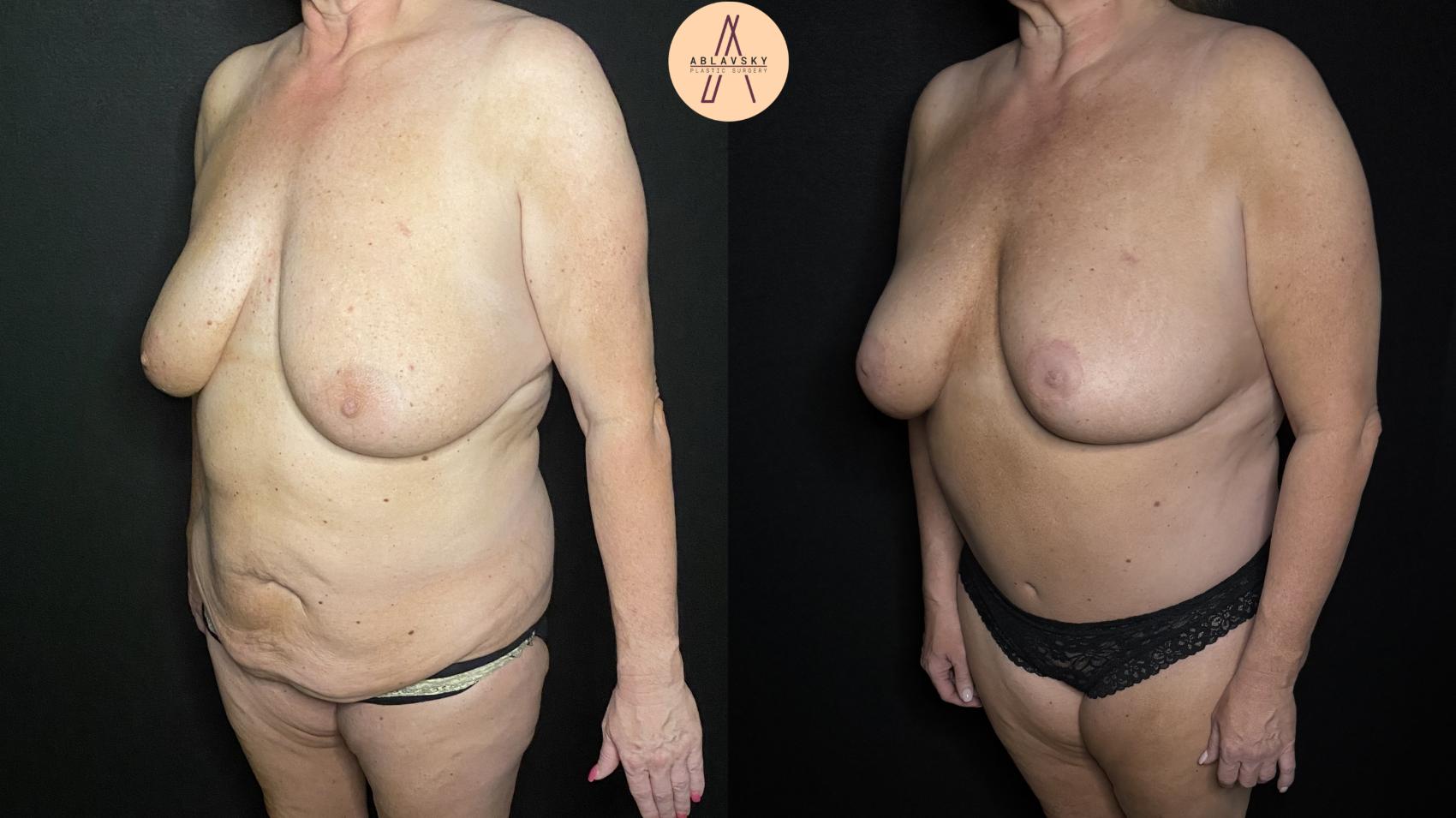 Before & After Tummy Tuck Case 338 Left Oblique View in San Antonio, Texas