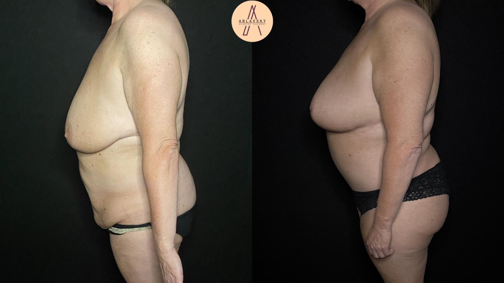 Before & After Tummy Tuck Case 338 Left Side View in San Antonio, Texas