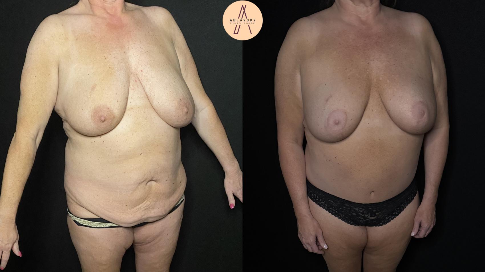 Before & After Tummy Tuck Case 338 Right Oblique View in San Antonio, Texas